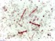 Lung asbestos bodies - Alex Brollo